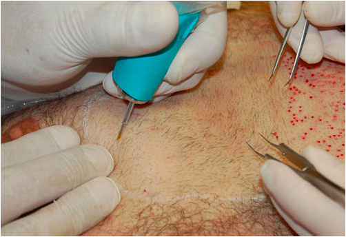 Everything You Should Know Before Shelling Out For A Hair Transplant Surgery